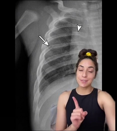 Exploring Rib Fractures and X-Ray Imaging