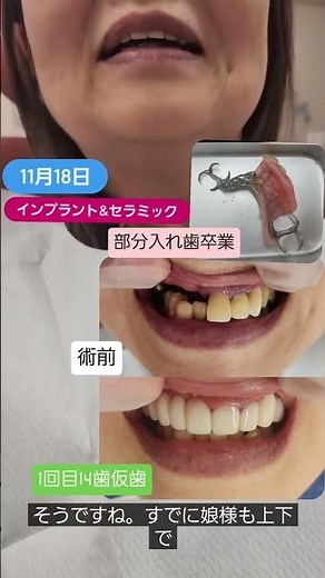 1回目が美しくなる日です。20年ほど部分入れ歯を使っていた方です。骨粗鬆症のお薬を飲んでいる影響もあり他院様ではインプラントは積極的にすすめられなかった方です #セラミック #インプラント