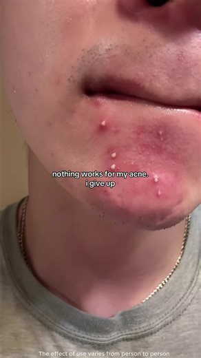 Fast acne care that actually works. Reduces pimples and swelling in 12 hours, fades acne marks in 7 days, dermatologically tested. #Acne#AcneCare #AcneTreatment #Skincare #SkincareRoutine #ClearSkin #HealthySkin