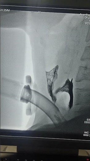 "Tracheoesophageal Fistula Visualized: A Glimpse into VFSS (Video Fluoroscopic Swallow Study)"