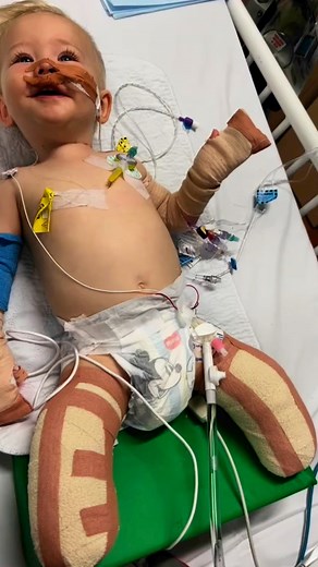 71K views · 21K reactions | two years ago today Ryan had his amputation surgery today he surprised us with this, taking some first little steps by himself 凉 #ryanscott #sepsis #sepsissurvivor #sepsisawareness #amptuee #disability #love #firststeps | Jessica Lines | Facebook