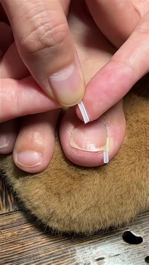 Toe Nail Fixer| Ingrown Toenail Cleaning & Care #ToenailFix #NailCare #FootCare #PedicureClean