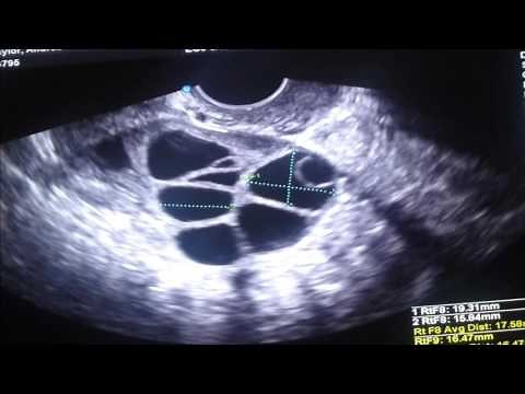 Day 9 Ultrasound - Growing Follicles Nearly Ready for Egg Retrieval