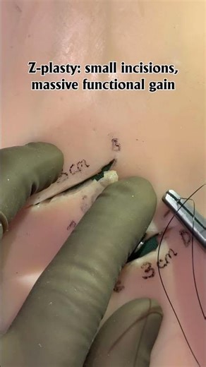 Z-Plasty: The Smartest Way to Release Scar Contracture