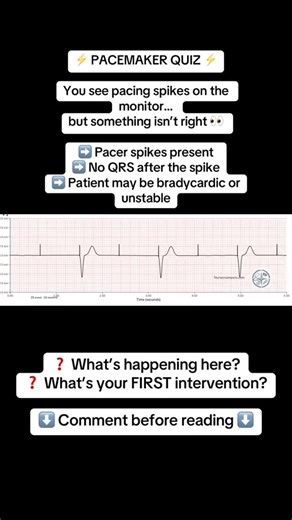CriticalCareRN-Friend on Instagram: "Failure to Capture ⸻ 🧠 WHAT IT MEANS: The pacemaker fires, but the myocardium does not respond. ➡️ Electrical impulse delivered ➡️ No depolarization occurs ➡️ No mechanical contraction ⸻ 🚑 NURSING PRIORITIES: 🔹 Assess the patient immediately (pulse, BP, symptoms) 🔹 Ensure pacer is actually connected and powered 🔹 Check lead placement 🔹 Increase pacing output (mA) per order 🔹 Correct causes: • Acidosis • Hypoxia • Hyperkalemia 🔹 Notify provider / cardi