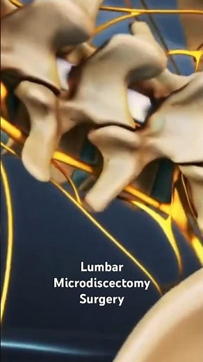 Lumbar Microdiscectomy Surgery