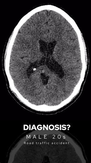 the Radiologist | Radiology | Male in his 20s presents with loss of consciousness after a road traffic accident. What does the CT head show? CEREBRAL CONTUSION... | Instagram