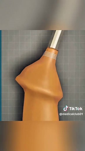 Understanding ZSR Circumcision Surgery Techniques