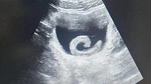 Man hospitalised after inserting live leech into bladder