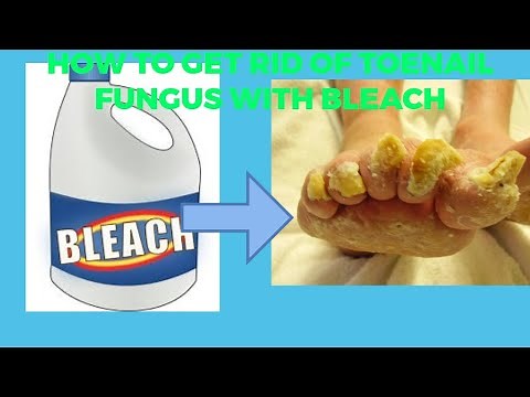 how to get rid of toenail fungus with bleach