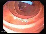 The Black Esophagus - Biliary Plastic Stent, Part 1 • Video • MEDtube.net