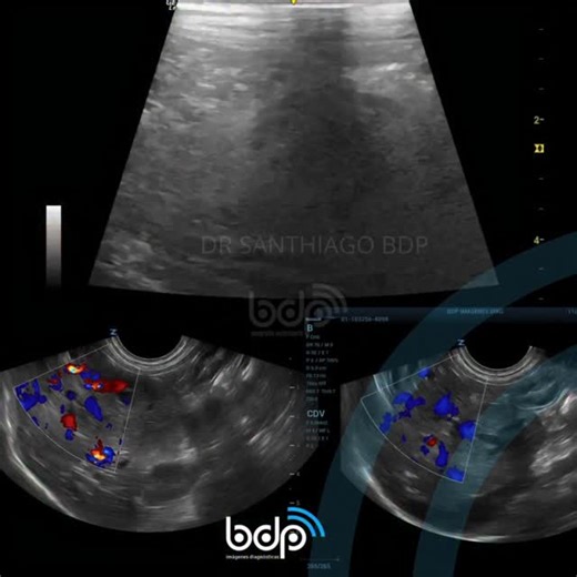 Un diagnóstico oncológico: Carcinoma hepatocelular bien diferenciado en perro. (Diagnóstico realizado por citología ecoguiada) La ecografía reveló una formación heterogénea en lóbulo caudado del hígado, con neovascularizacion con características sugerentes de infiltrado neoplásico, de realizó toma de muestra por aguja fina con el resultado citológico de carcinoma hepatocelular (HCC) bien diferenciado. #bdpimagenesdiagnosticas #bdpecografiaveterinaria #vetultrasound #ecobdp #ecografiaveterinaria 