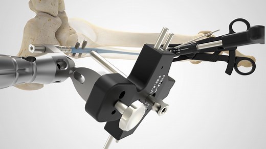 Fibula Nail 2 Surgical Technique Overview Animation