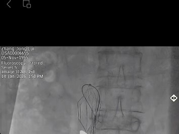 loop 法抓捕滤器操作步骤