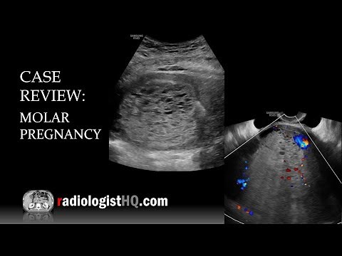Case Review: Ultrasound of Complete Molar Pregnancy