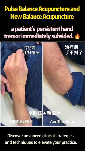 By balancing the internal organs using Pulse Balance Acupuncture and performing New Balance Acupuncture at LI10 (Shousanli), a patient’s persistent hand tremor immediately subsided. ✨ Key Techniques • Pulse Balance Acupuncture: Restores energy flow and organ balance • New Balance Acupuncture: Focuses on yin-yang harmony through precision needling 📢 Join Our Course! Join our upcoming New Balance Acupuncture workshops for in-depth training! 📍 Locations: • London-UK‣ 25-27/4/2025 Register here - 