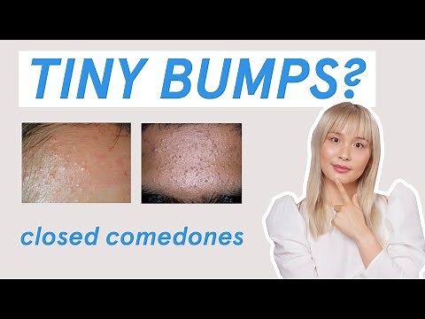 Why those tiny bumps AREN’T fungal acne!