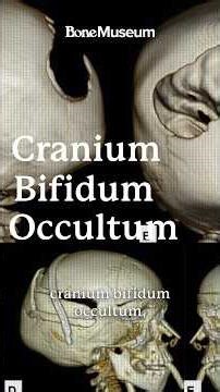 What is Cranium Bifidum?