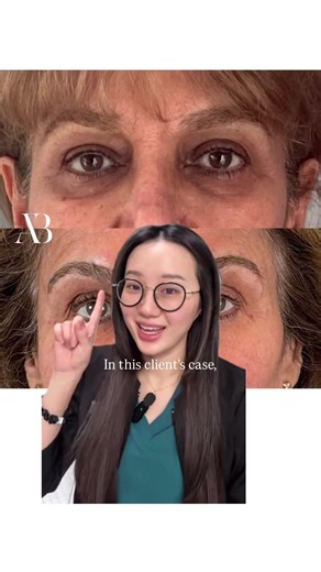 How to Get Rid of Dark Circles (Why Nothing Has Worked)