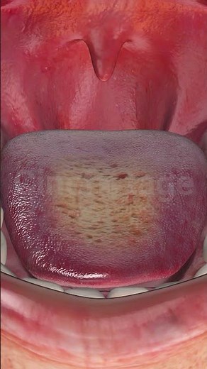 Close Up of Fungal Infection on Human Tongue stock footage | stock video | Cinefootage