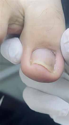 See How a Painful Toenail Ingrown Gets Fixed in Minutes!