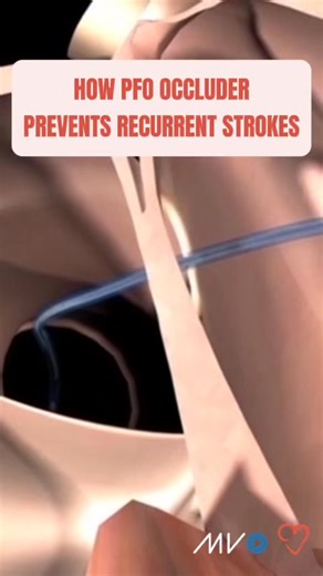 A 'small hole in the heart', aka Patent Foramen Ovale, can increase your risk of stroke. It’s present in about 25% of the population, often harmless, but in some patients, it becomes a dangerous gateway for clots to travel to the brain. ⁠ A PFO occluder is a minimally invasive device placed via catheter. It seals the opening and reduces the risk of another stroke. ⁠ Watch the full story of one patient’s stroke recovery with the AMPLATZER™ PFO Occluder: https://www.youtube.com/watch?v=iKRXwzuSiGw
