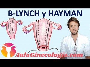 B-LYNCH and HAYMAN: EMERGENCY UTERINE PLICATIONS FOR UTERINE ATONY. - Gynecology and Obstetrics