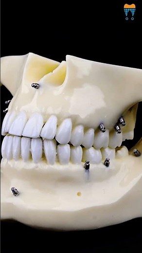 iDENTical Orthodontic Implant Model M2016 - Comprehensive Orthodontic Tool | Mini Implant Placement
