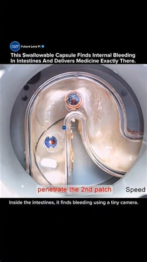 Magnetic Robotic Capsule Endoscope Delivers Targeted Drugs Inside GI Tract #medicine #tech #shorts