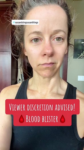 What to do for a blood blister!? Do you pop it or do you leave it? Do you wrap it up or do you let it breathe??#bloodblister #bloodblistershurt #susandoingsusanthings #helpmeouttiktok @susandoingsusanthings