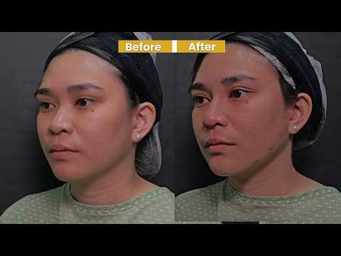 Profile Enhancement: Nose, Chin, and Jawline Harmonization | Dr. Contessa Salvador