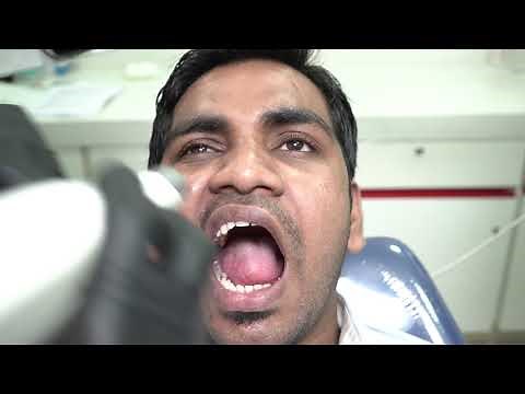 Digital Implant Workflow with 3Shape