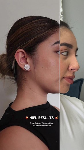 Amazing HIFU Results in Sydney - Before and After Transformation