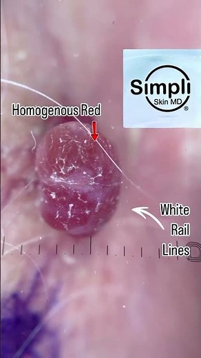 What’s That Bump? Dermoscopy Time!