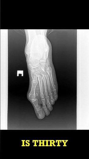 Foot X-Ray Spot the Hallux Valgus! #radiology short