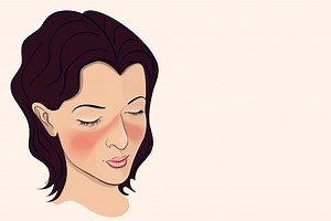 Signs of Lupus in Women