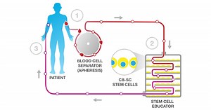 Breakthrough stem cell therapy opens new treatment paths for autoimmune patients
