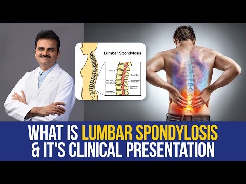 What is Lumbar Spondylosis & It's Clinic Presentation |Dr. Ravi Kumar, Neuro Surgeon (Brain & Spine)