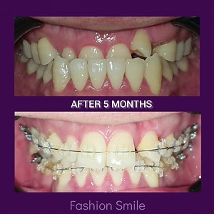 Do you know What type of Bite is this? This is called Class III malocclusion ▫️Class III bites are often referred to as an underbite. This occurs when the lower molars are positioned more towards the front of your mouth than the upper molars. As a result, your lower teeth and jaw project out beyond the upper teeth and jaw. ▫️ #healthysmilehealthylife ▫️ We are here for you, Contact us⬇️ . 🌎http://fashionsmile.ph/ 📬admin@fashionsmile.ph . 📍601 Heart Tower,108 Valero St., Salcedo Vil. Makati ci