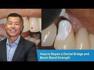 How to Repair a Dental Bridge and Boost Bond Strength | Dentist 2 Dentist
