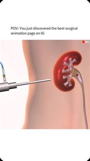 Animations | Follow @surgicalanimation for more! 🏥 | Instagram