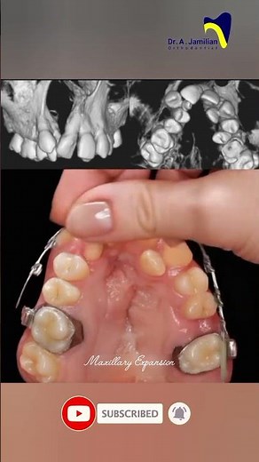 Upper Jaw Expansion for Crowded Teeth: Creating Space Naturally #expansion #crowding #orthotics