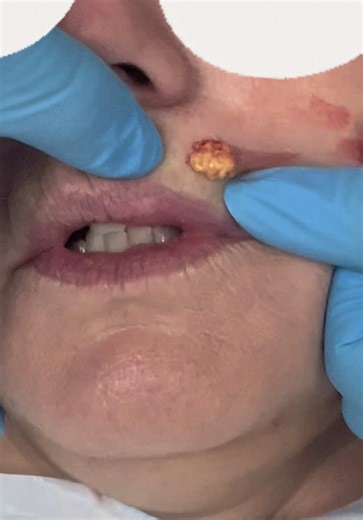 Understanding Lip Filler Migration and Safe Dissolving