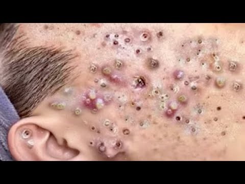 Cystic Acne Removal & Inflammatory Acne - #0188 #acne