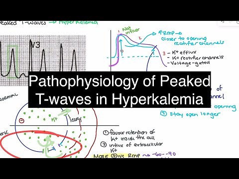 Hyperkalemia Explained: Pathophysiology of Peaked T-Waves