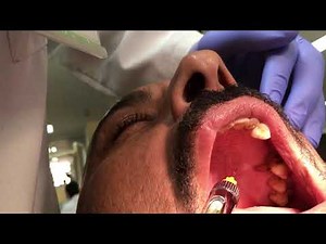 Palatal Anesthetic Infiltration Technique