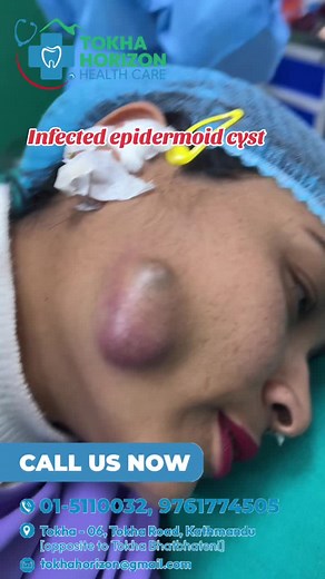 Multiple Lipoma Removal at Tokha Horizon Polyclinic