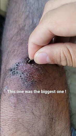 Picking my Giant scab, the biggest one yet! Finale