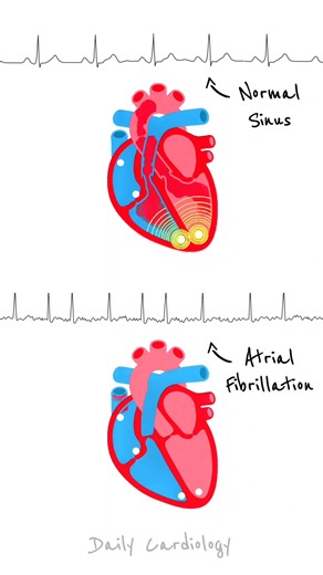 Heart's Conduction in Normal Sinus Rhythm vs Atrial Fibrillation | Daily Cardiology