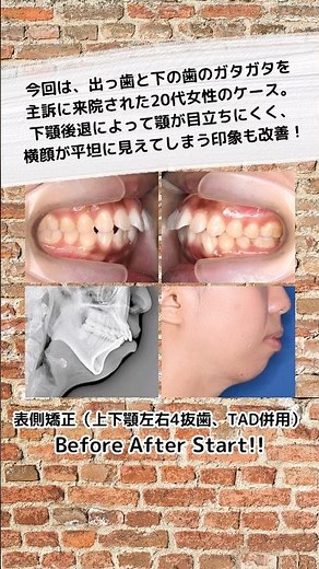 【症例81ショートver.】顎なし「下顎後退」不正咬合と顔の印象を矯正治療で改善 #shorts #顎なし #下顎後退 #出っ歯